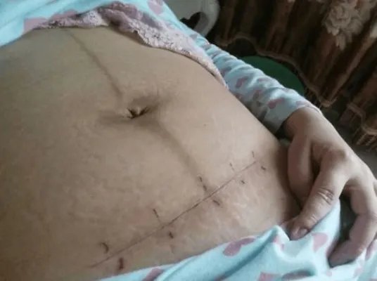 女子3次剖腹 打开肚子医生惊恐(图)