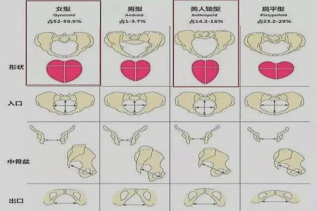 女性骨盆分为4种类型图片