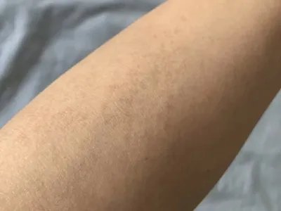 家族性进行性色素沉着症斑图片