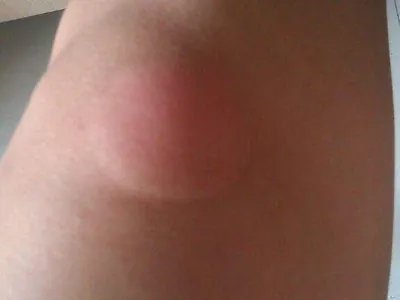 Ⅰ型痛性肥胖病症状图片