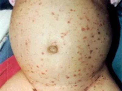 勒-雪病症状图片