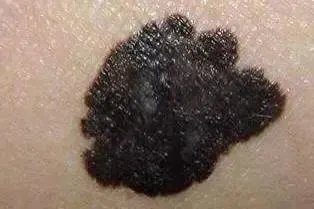 黑痣癌早期图片