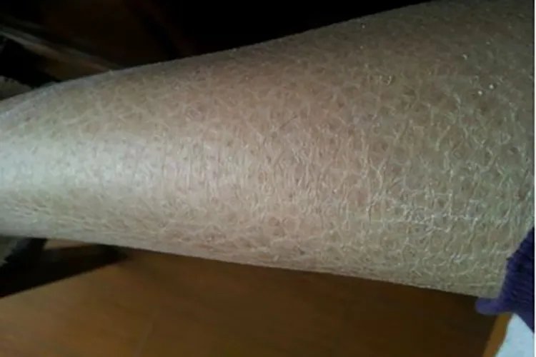 鱼鳞皮肤病症状图片