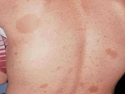 咖啡斑症状图片