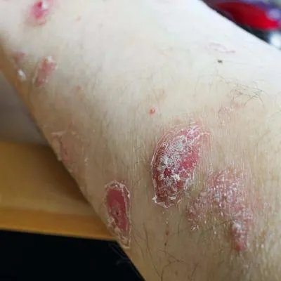 怎样让牛皮癣不复发