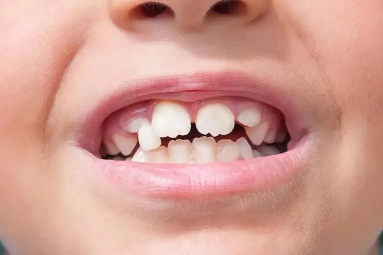 牙齿不平整图片