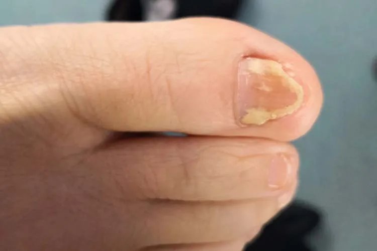 什么是灰指甲症状图片