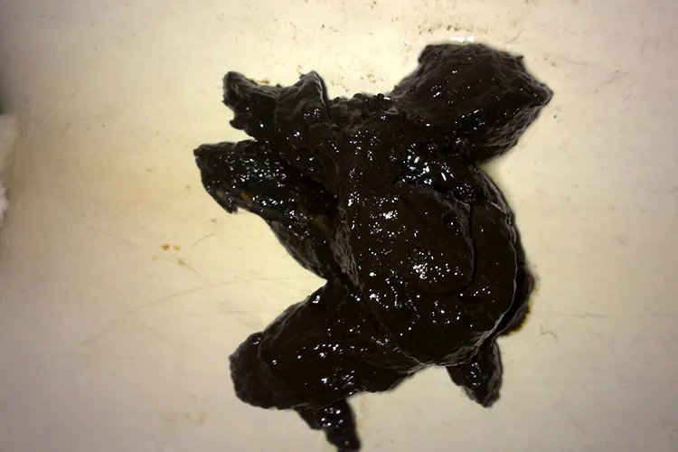 肠癌早期症状粪便图片