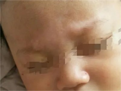 家族性进行性色素沉着症斑图片