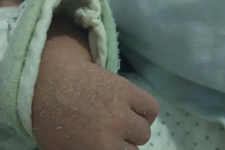 手癣图片初期症状图片大全