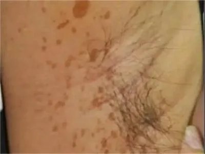 咖啡斑症状图片