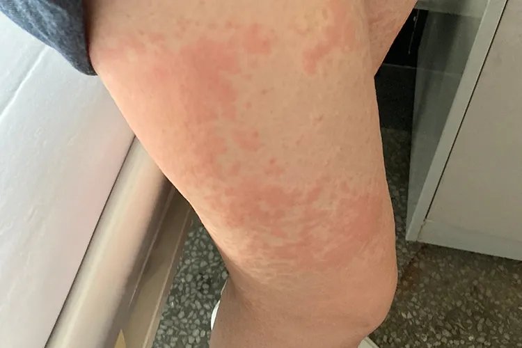 螨虫咬后的皮肤图片