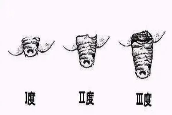 严重脱肛图片症状图片