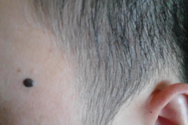 脸上长黑痣图片
