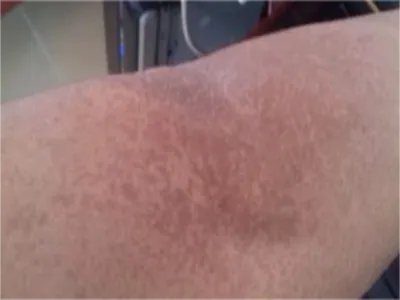 家族性进行性色素沉着症斑图片