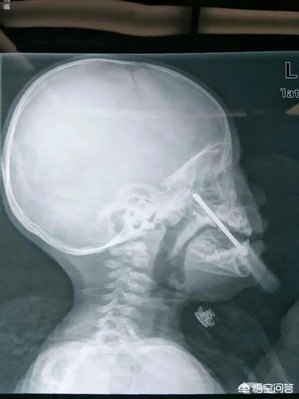 作为医生，你们见过的最幸运的病人有多幸运？