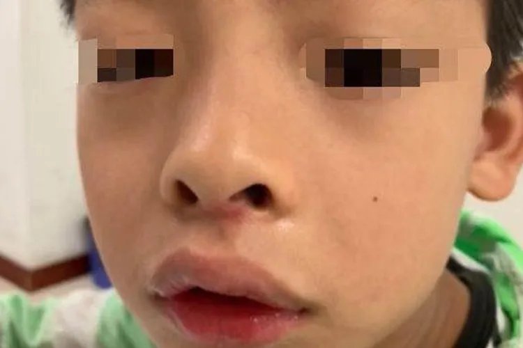 儿童腺样体面容图片