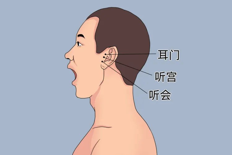 耳鸣针灸的部位图片