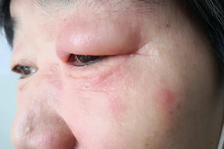 丹毒的症状图片