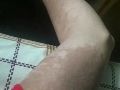 咖啡斑症状图片