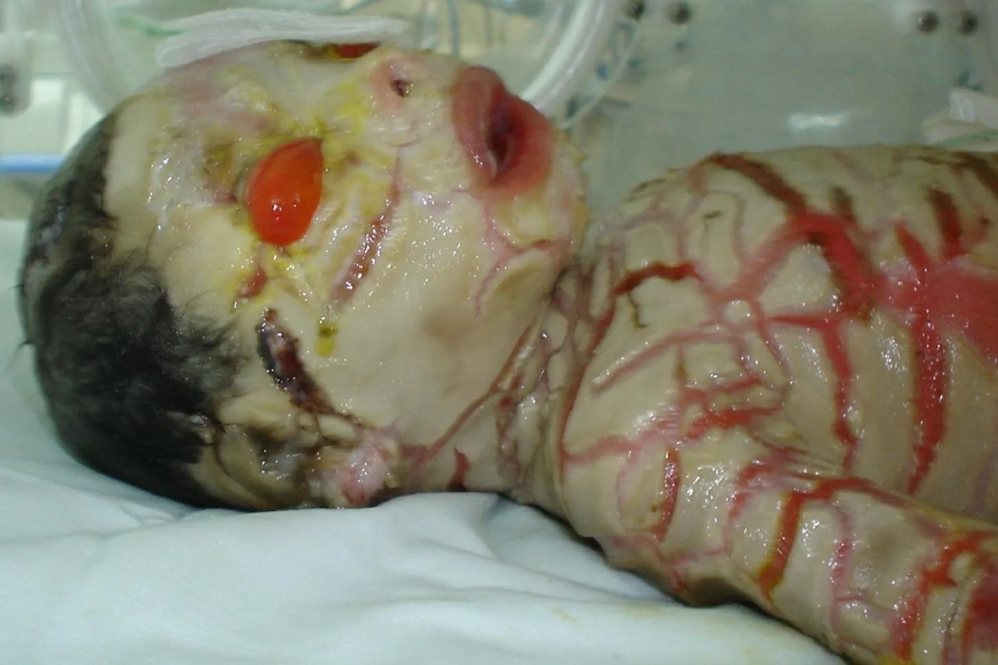 火棉胶婴儿真实图片