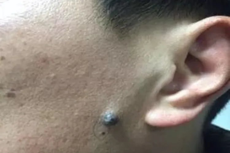 痣什么样子图片