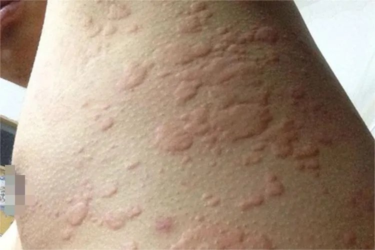痒疹图片症状