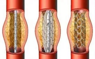 装支架就废了?北京安贞医院心内科专家带您走出误区!!