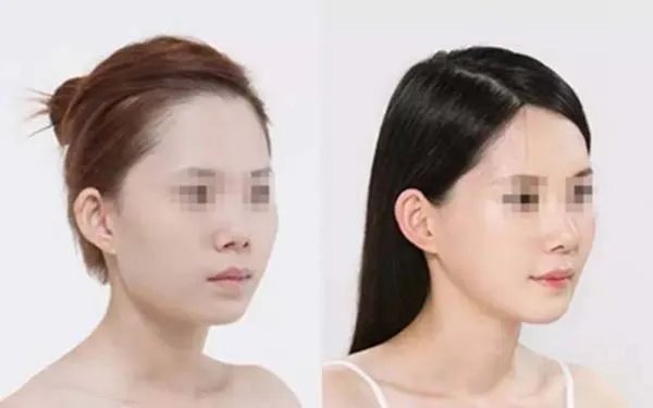 北京做玻尿酸隆鼻到哪个医院好