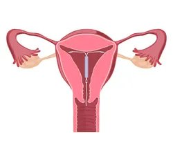 输卵管不孕，济南青华医院为您解决