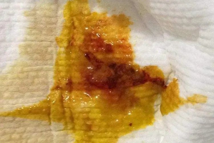 肠癌早期症状粪便图片