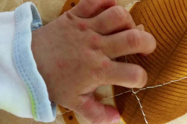 手足口病轻微图片