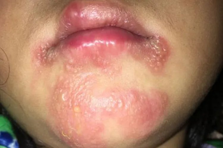 儿童蛇胆疮图片大全