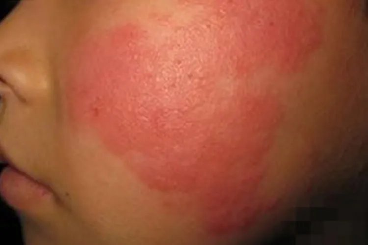 过敏的症状图片