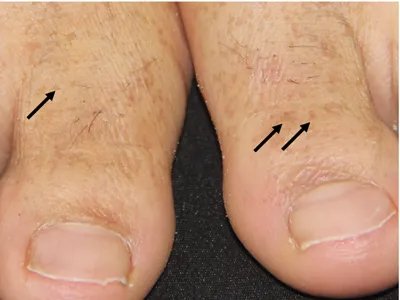 家族性进行性色素沉着症斑图片