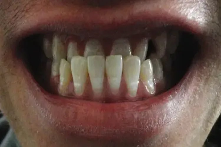 牙齿不平整图片