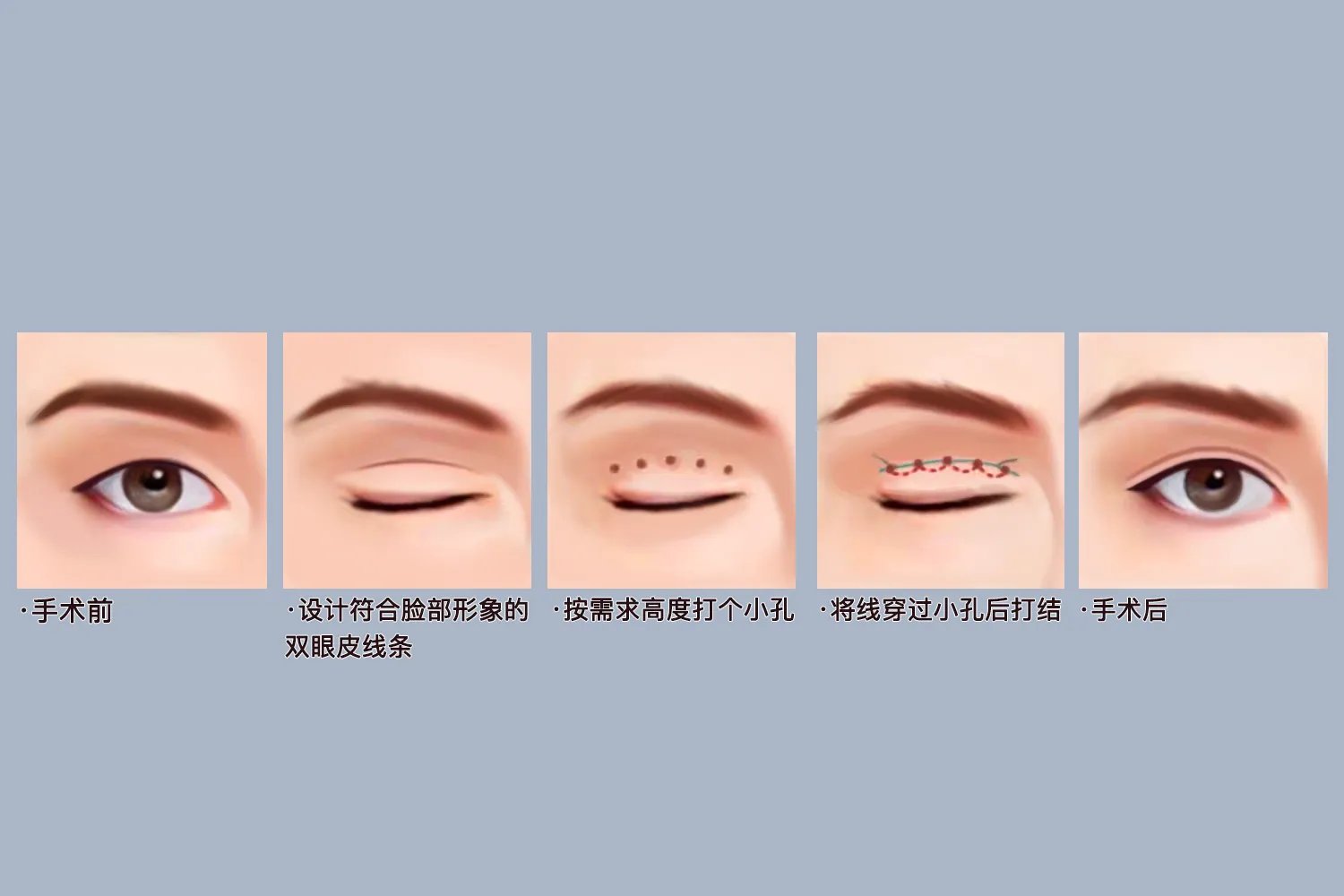 双眼皮手术图片