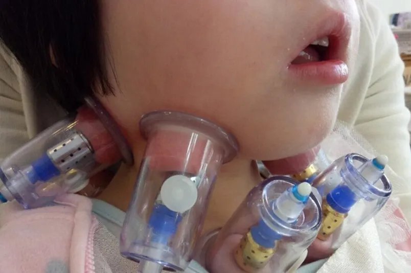 6岁娃腺样体肥大面容照片