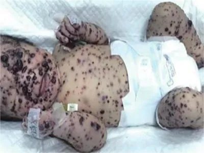 勒-雪病症状图片