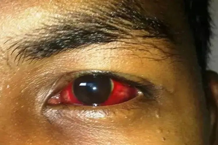 登革热皮肤症状图片