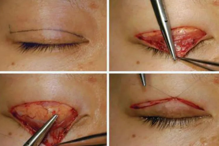 双眼皮手术图片