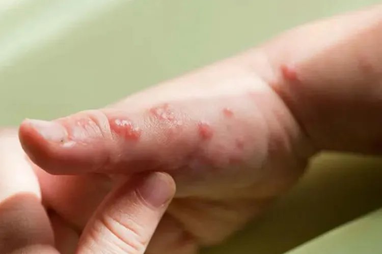 儿童蛇胆疮图片大全