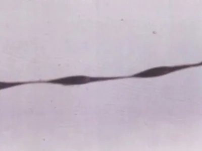 念珠状发症状图片