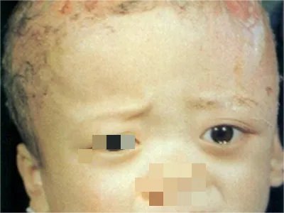 勒-雪病症状图片