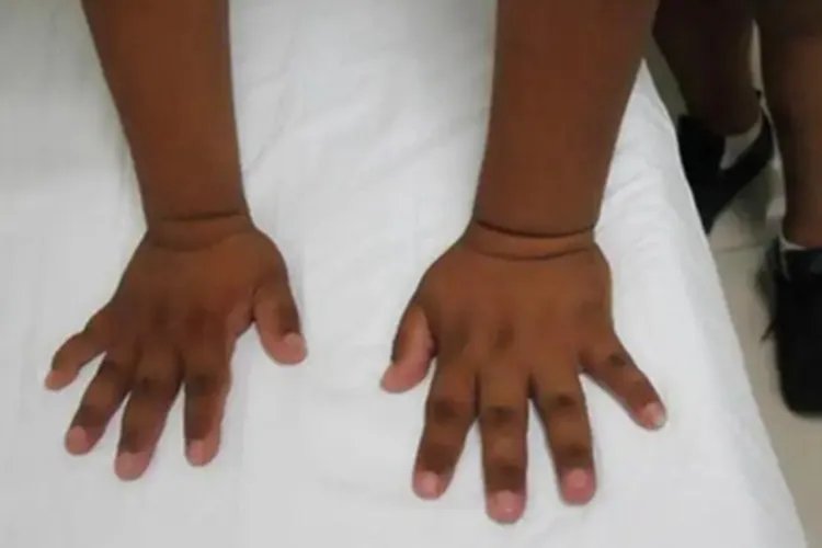 肢端肥大症症状图片