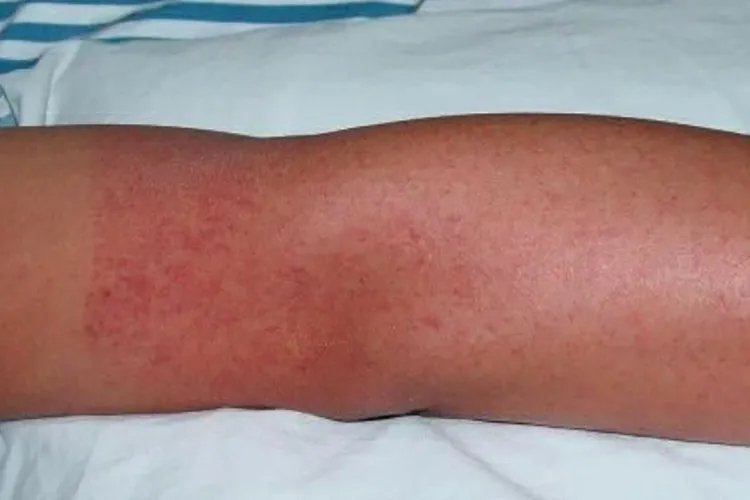 登革热皮肤症状图片