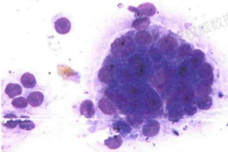 癌细胞真实图片