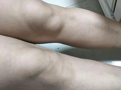 Ⅰ型痛性肥胖病症状图片