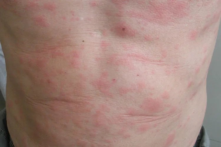 过敏的症状图片