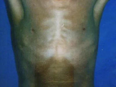 家族性进行性色素沉着症斑图片